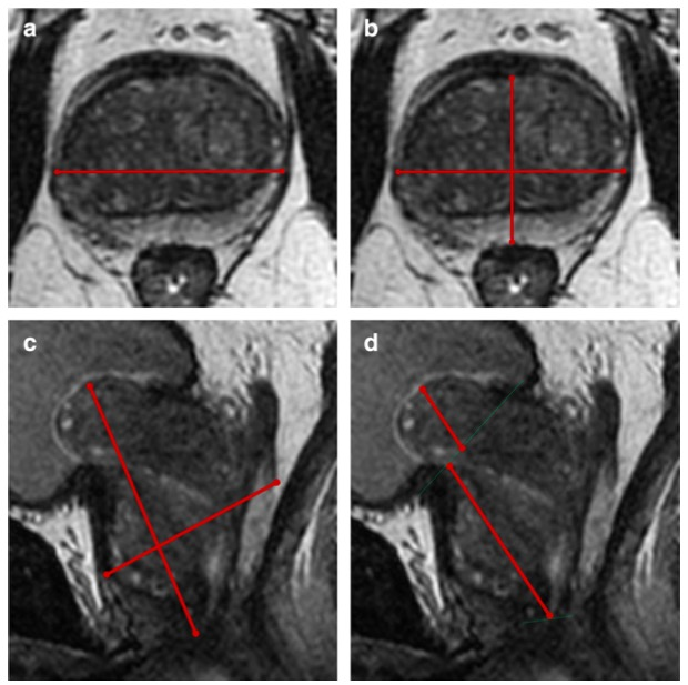 European Radiology：MRI对前列腺体积的测量的新方法