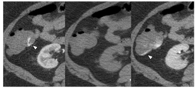 European Radiology：平扫和延迟期可以提高动脉CTA对活动性下消化道出血的诊断