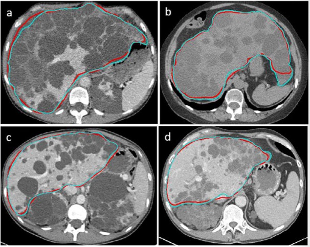 European Radiology：如何实现CT上多囊肝的快速自动分割？