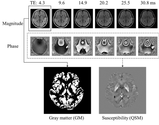 European Radiology：QSM和VBM在阿尔茨海默病早期诊断的中的应用