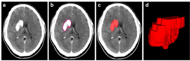 European Radiology：如何鉴别机械性血栓切除术后颅内<font color="red">造影</font>剂外渗与脑内出血？