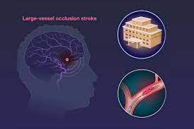 NEJM重磅证据：大面积急性脑梗也应该及时进行血管内治疗！