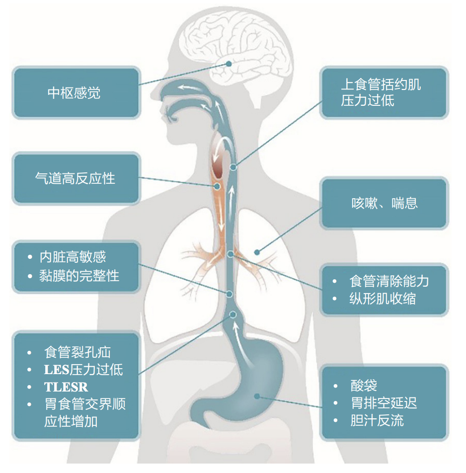 3张图，牢记胃食管反流的诊断和治疗！