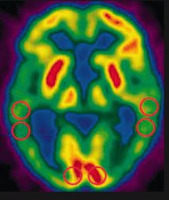 JAMA子刊：临床前老年痴呆患者的皮质PET<font color="red">成像</font>模式的差异性