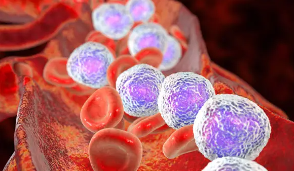 Leukemia：Guadecitabine（SGI-110）在外周T<font color="red">细胞</font><font color="red">淋巴瘤</font>中的综合临床评估