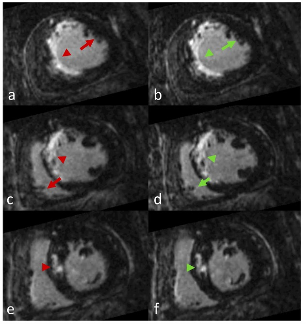 European?Radiology：iNAV<font color="red">三</font>維心肌Dixon LGE<font color="red">成像</font>在臨床中的應(yīng)用