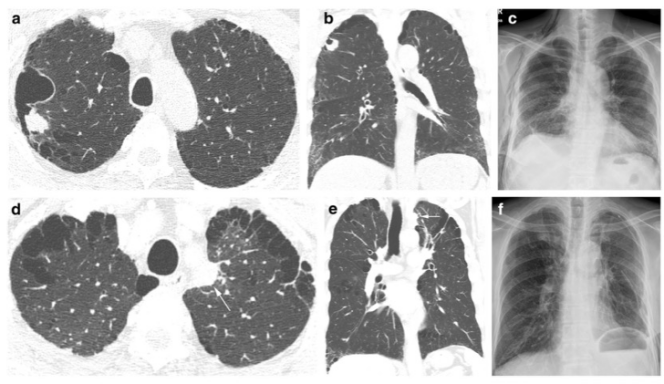 Eur Radiol：肺癌患者的这一CT征象，你一定不要小看！