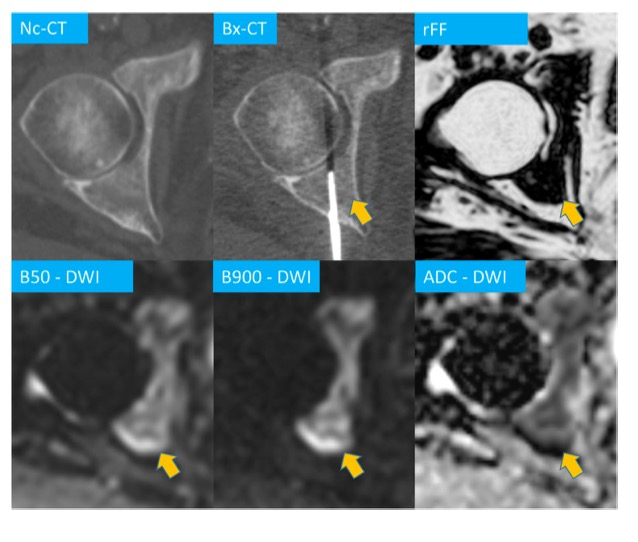 European Radiology：多参数骨MRI在骨转移瘤活检靶点选择中的应用
