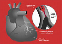 Eur Heart J：非ST<font color="red">段</font>抬高急性冠脉综合征患者有创治疗策略的时机选择！
