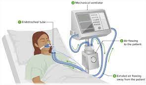 JAMA：接受机械通气的严重中风患者，早期与标准方法的气管切开对功能恢复的影响