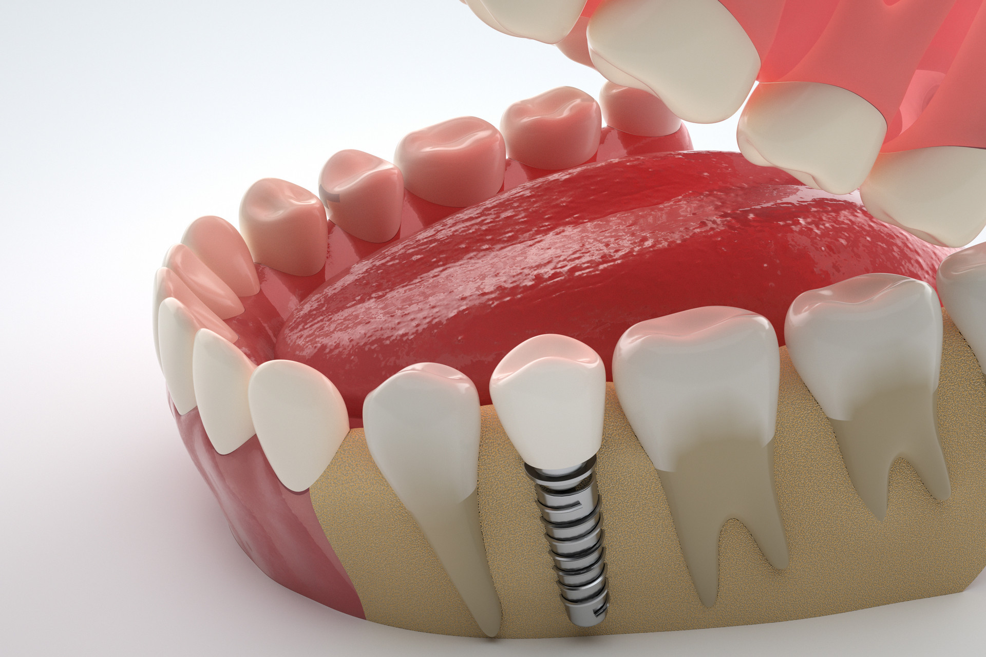 Clin Oral Implants Res：种植<font color="red">体</font>冠螺丝固位vs.<font color="red">粘结</font>固位5年结局对比