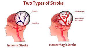 Stroke：除了脑血管的问题，其它中风的病因还有这些！