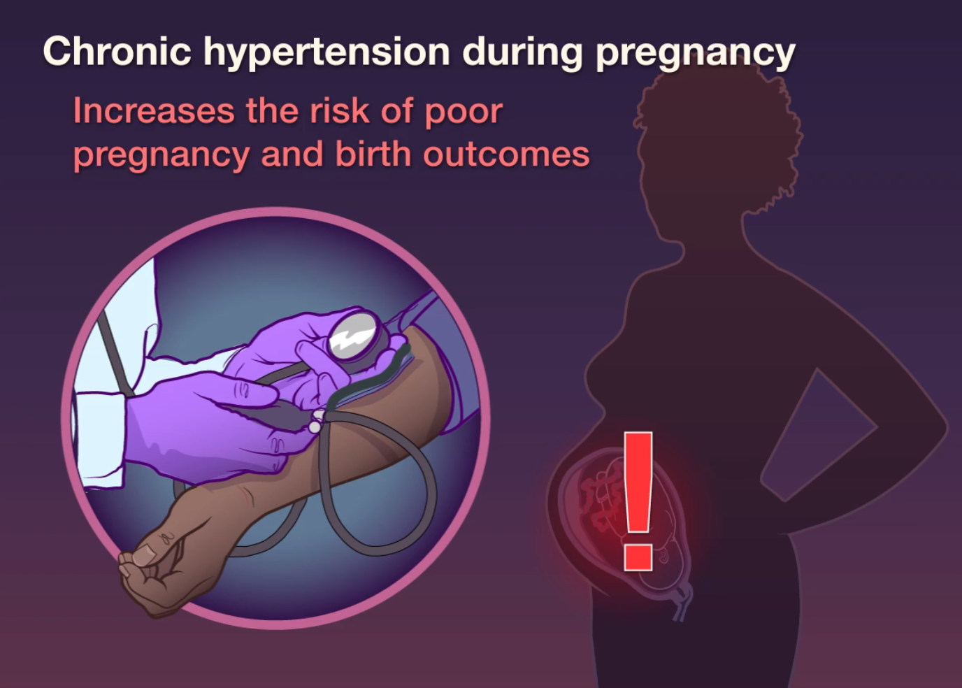 NEJM：孕期轻度慢性高血压的治疗