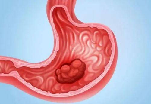 J Gastroenterol：胃癌筛查计划对胃癌患者的长期预后的<font color="red">影响</font>