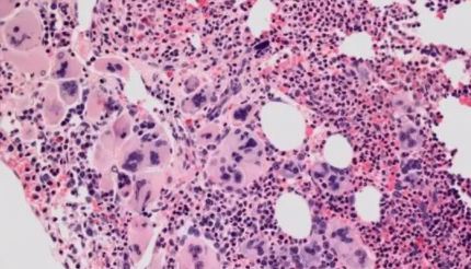 Lancet Haematol：鲁索替尼加用Navitoclax治疗骨髓纤维化的<font color="red">分子</font>生物标志物分析