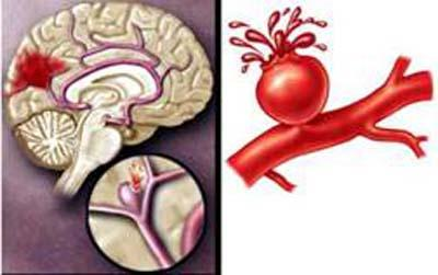 Neurology：生育<font color="red">年限</font>短、绝经过早者易发生动脉瘤性蛛网膜下腔出血