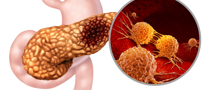 Cell子刊：研究发现最常见胰腺癌的新治疗靶点！