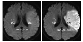 J Neurointerv Surg：低相对弥散加权图像信号强度可预测<font color="red">急性</font><font color="red">缺血性</font>卒中患者血管内血栓切除术后的良好预后