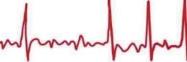 JAMA Cardiol：心肌病和心律失常相关基因罕见变异会增加<font color="red">早</font>发型房颤患者的死亡率
