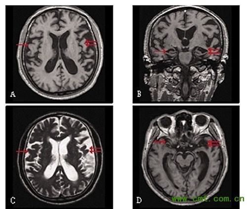 Molecular Psychiatry：额颞叶变性谱系存在与<font color="red">情绪</font><font color="red">处理</font>相关的共同功能脆弱性模式