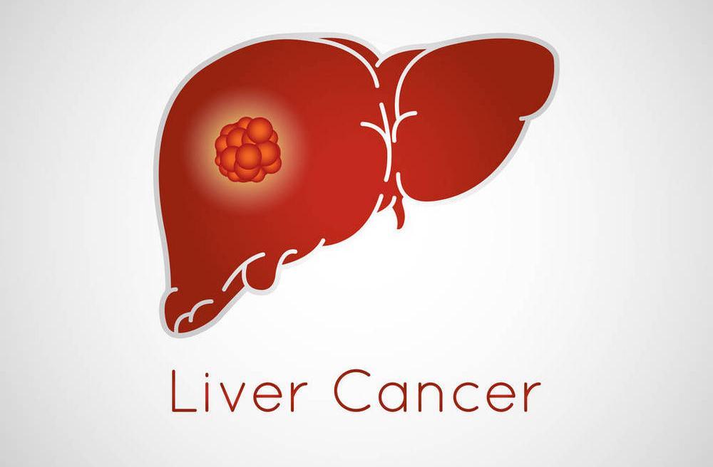 2022 ASCO：通过个性化和肿瘤知情的ctDNA检测监测肝细胞癌患者肝脏移植后疾病<font color="red">复发</font>的可行性
