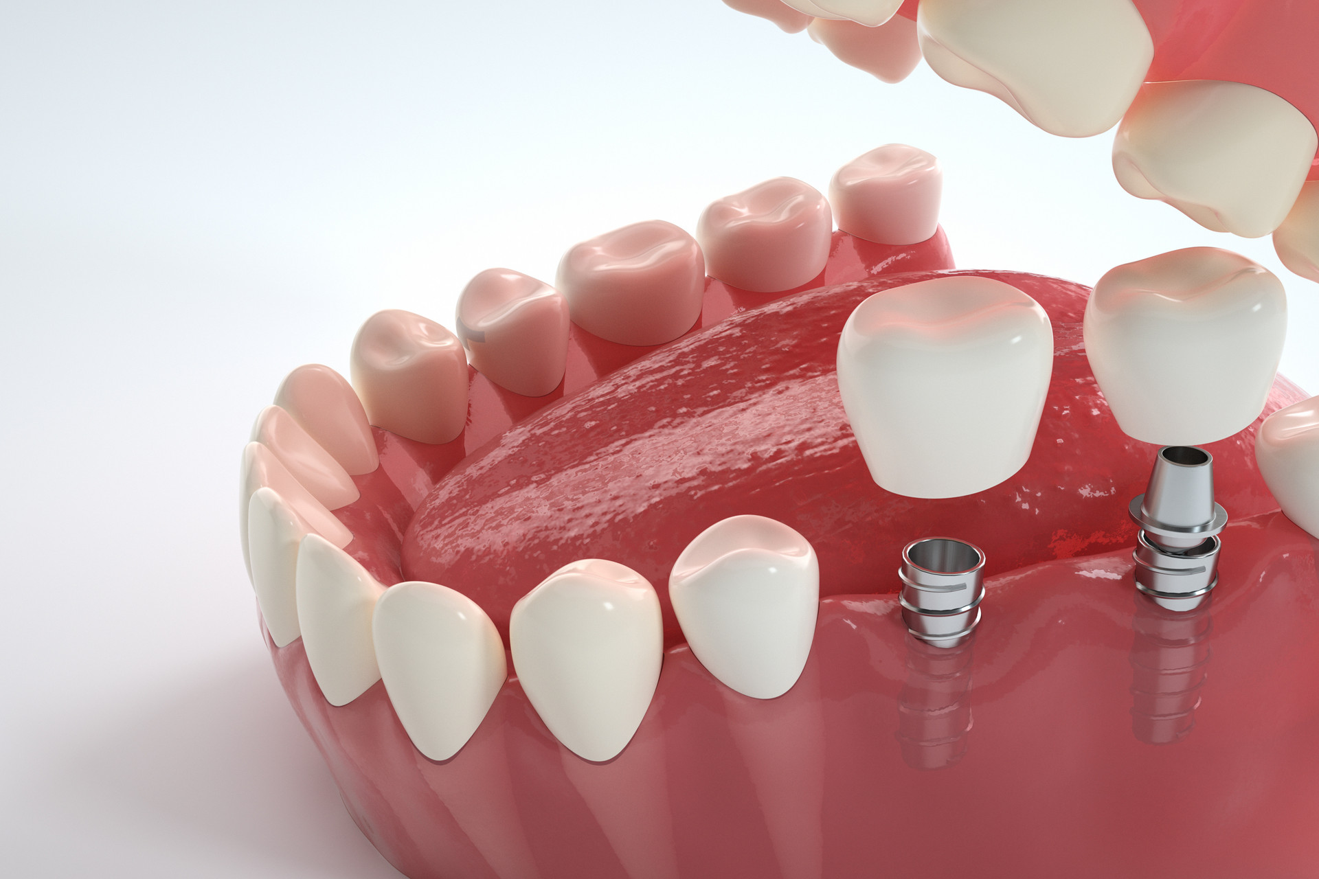 Clin Oral Implants Res：辅助<font color="red">性</font>全身应用抗生素是否可有效治疗种植<font color="red">体</font>周围<font color="red">炎</font>？
