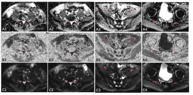 European Radiology:近端神经<font color="red">DTI</font>在鉴别CMT亚型中的应用