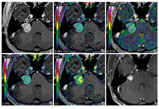 European Radiology:<font color="red">前庭</font><font color="red">神经</font><font color="red">鞘</font><font color="red">瘤</font>伽GKRS术前的动态增强MRI的反应预测