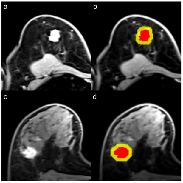 European Radiology:基于MRI的放射组学模型在浸润性乳腺癌导<font color="red">管内</font>成分预测中的应用