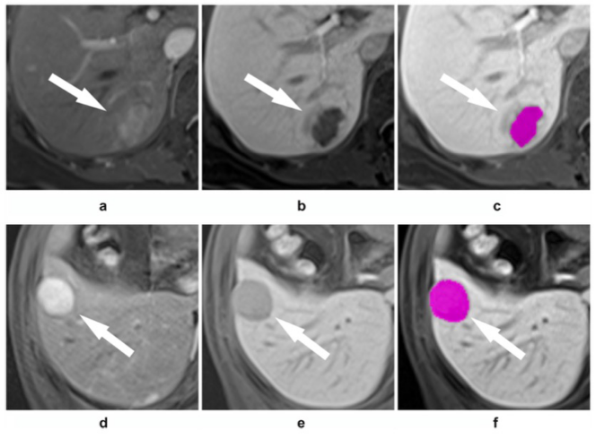 European Radiology:三维定量MRI技术可实现术前小肝癌的<font color="red">微血管</font>浸润预测