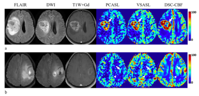 European Radiology：VSASL技术在脑胶质瘤定性、定量分析的应用