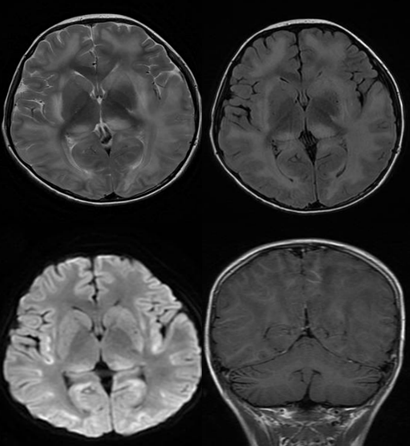 JNNP:MRI的T2弛豫时间可作为视神经脊髓炎谱系障碍诊断的标志物