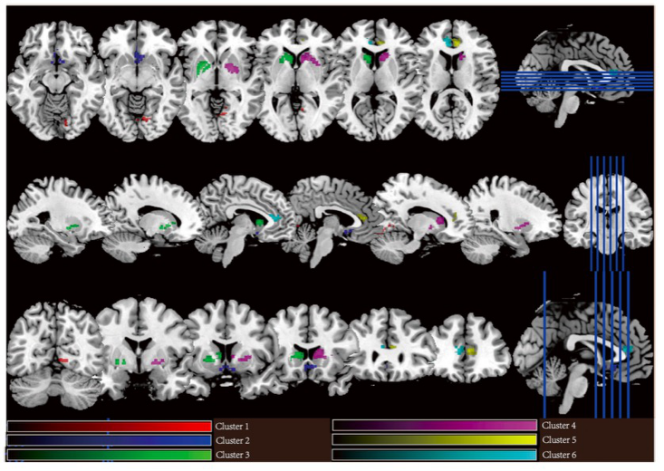 European Radiology：这一影像学技术，揭示了注意力缺陷/多动症儿童的大脑异常！