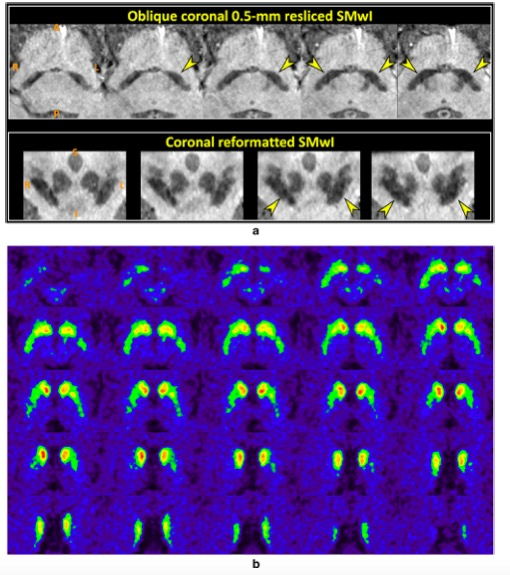 European Radiology：帕金森病的SMwI MRI前瞻性多中心研究