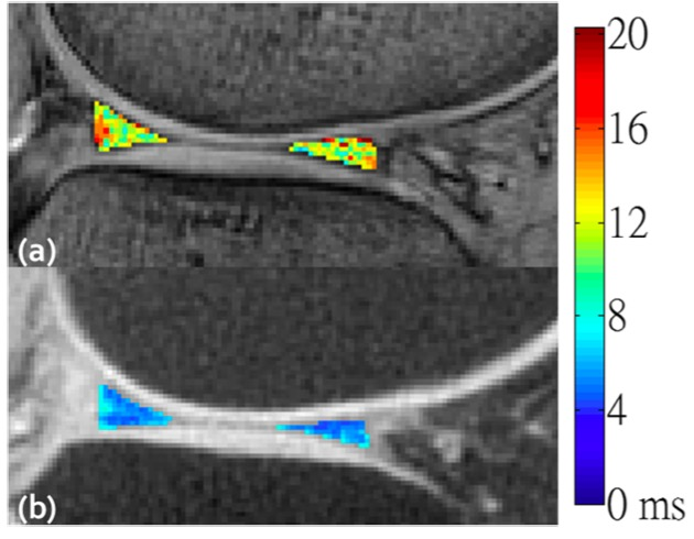 European Radiology：T2*mapping在显示膝骨关节炎患者早期半月板异常中的价值