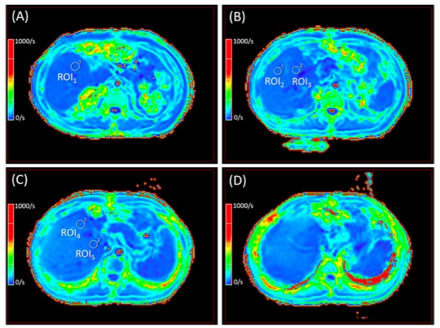 European Radiology：利用BOLD磁共振成像检测肝移植后急性细胞排斥<font color="red">反应</font>