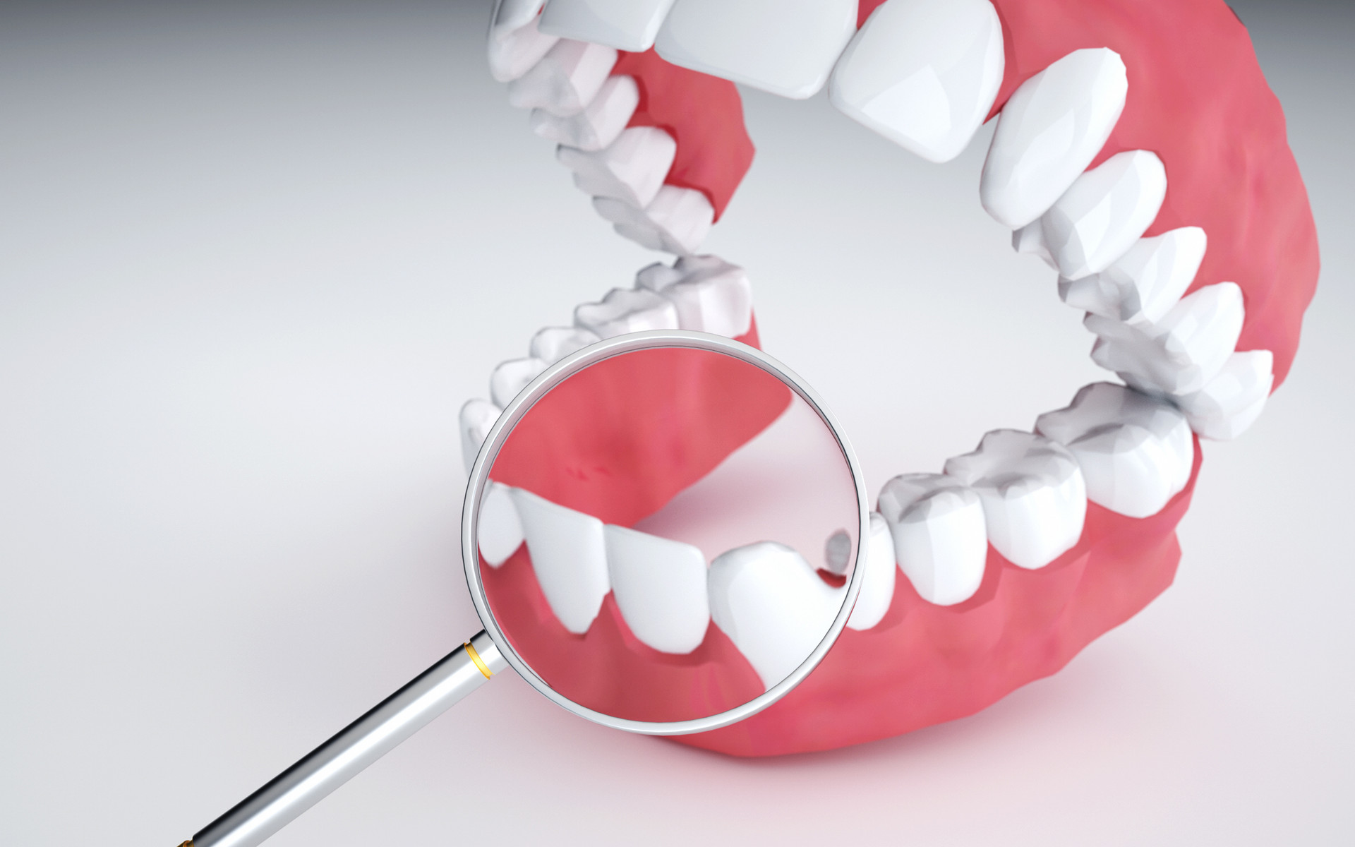 Oral Oncol：外用氟化物可有效预防成人放射性<font color="red">龋齿</font>
