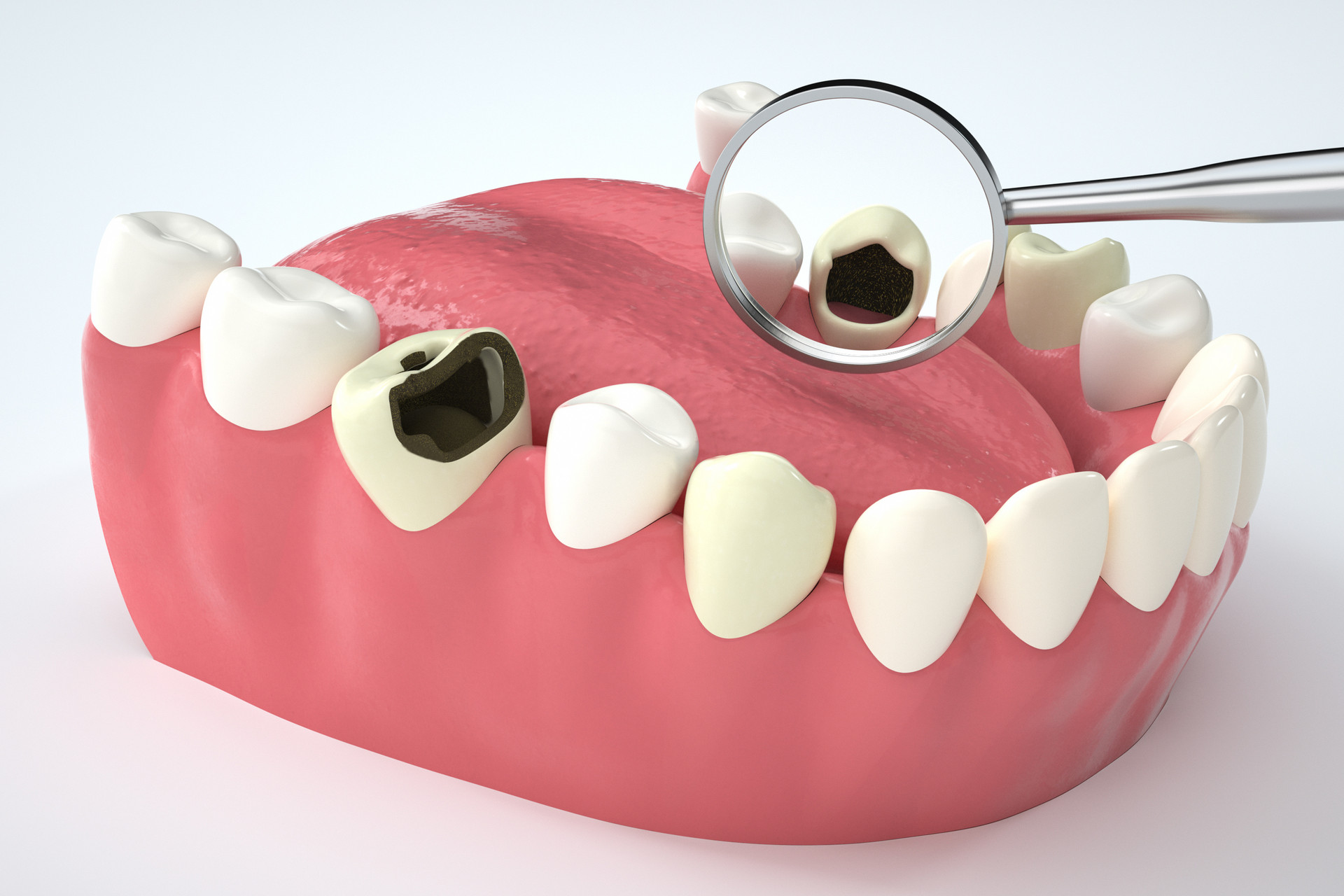 Clin Oral Investig：纳米羟基磷灰石能预防龋齿吗？