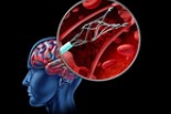 stroke：血管内卒中治疗后无症状颅内出血的决定因素——一项回顾性队列研究