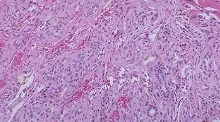 Clin Cancer Res：新型PD-L1抗体TQB2450联合安罗替尼治疗局部晚期/转移性软组织肉瘤
