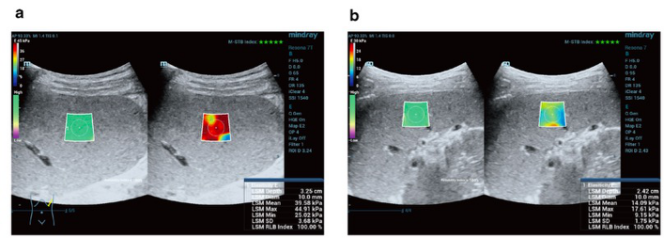 European Radiology：脾脏硬度在肝脏纤维化分级的应用