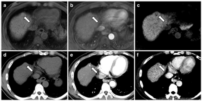 European Radiology：在肝硬化患者中遇到这种肝结节一定要谨慎！ 