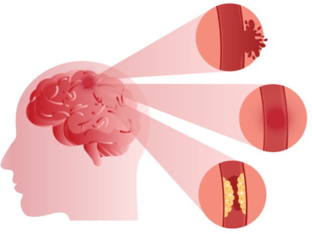 Stroke：如何对短暂性脑缺血发作或小中风后进行多模式预防