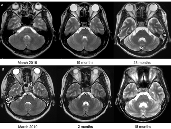 Annals of Clinical and Translational Neurology：小脑体积减少可能反映NMDAR脑炎疾病负担和进展程度