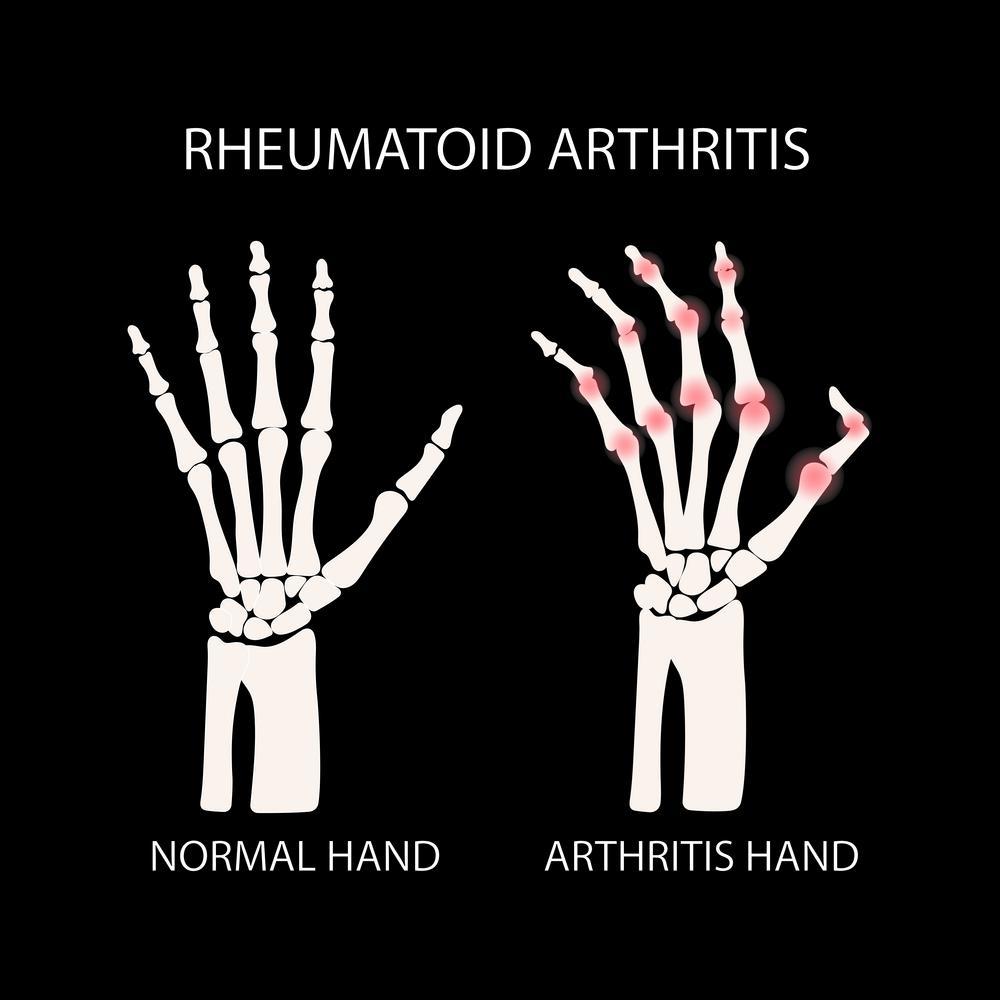 Arthritis Res Ther: 靶向治疗对老年类<font color="red">风湿</font>关节炎患者安全有效