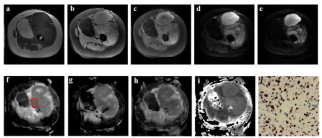 European Radiology:用这个MRI序列，对软组织肉瘤进行病理级放大！