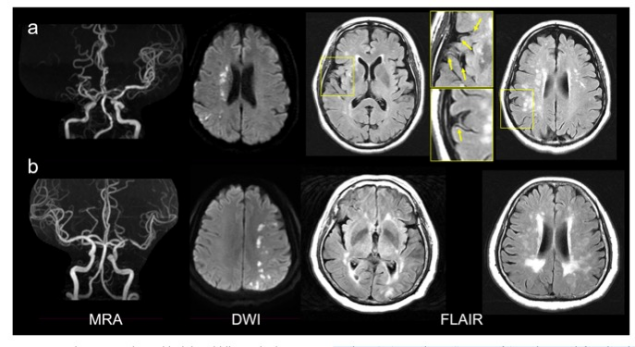 European Radiology:在<font color="red">FLAIR</font>上的这一征象可预测药物治疗的急性缺血性脑卒中患者的功能预后
