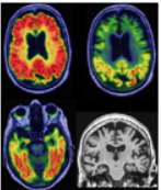 Alzheimer&Dementia：新发现——临床前阿尔茨<font color="red">海</font>默病的诊断性<font color="red">和</font>预后性血浆<font color="red">生物</font>标志物