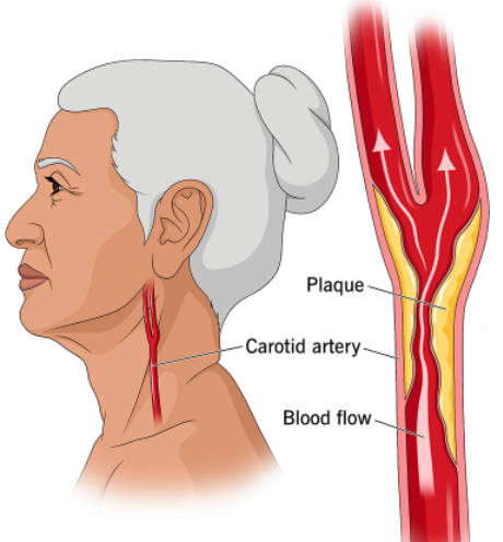 stroke：靶向血浆蛋白组学结果，这几类蛋白可以准确预测颈动脉斑块的发展