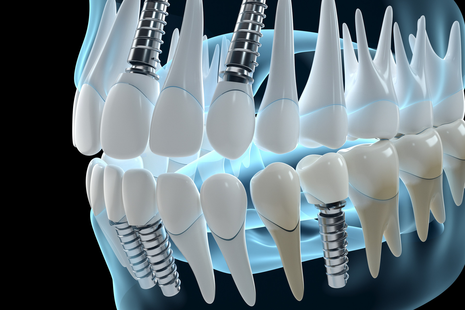 J Clin Periodontol：自体牙根在垂直和水平牙槽脊联合增高术和分段种植中的疗效和安全性相当